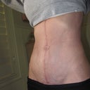 6 weeks post op