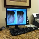 Before and after on computer....After also shows small chin augmentation that I opted not to go for due to cost and horrible reviews. My chin sticks out plenty when I'm smiling.