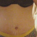 2 weeks after.. i'm still very swollen. (i can tell because my binder is leaving indents in my belly.)