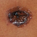 7 Days Post Op Bellybutton