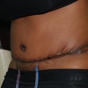 7 Days Post Op