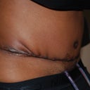 7 Days Post Op