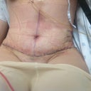 Post op day 2!