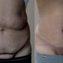 Before & After (Post op 2.5 weeks). Still really swollen