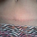 scar at 6 months po