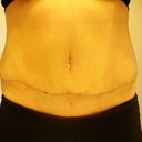 Tummy Tuck post-op