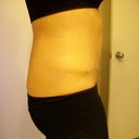 Tummy Tuck post-op
