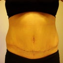 Tummy Tuck post-op