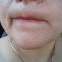 showing the scars, my right side is way worst than the left