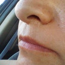 white line ( scar )