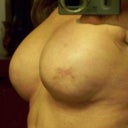 Notice the upper part of breast and how it has a natural slope that u can really notice on the far breast. Again this is only 4 weeks out so we still have some touching up to do.