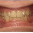 Start of treatment