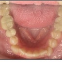 Start of treatment