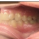 Start of treatment