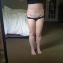 Scar, 2 weeks post op