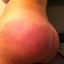allergic reaction 5 weeks post op