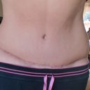 33 days po and I HATE my hips. I hope it's just swelling