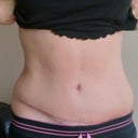 33 days po you can see how much higher my scar is on the one side to the other