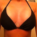 After :) Same day as surgery