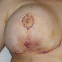 Day 2 Post Op of right breast