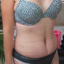33 days post op
