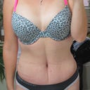 33 days post op