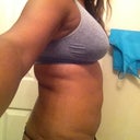Side view pre-op