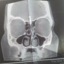 deviated septum