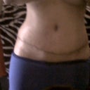 hopin my scar gets better soon..so far ok w it super low and healing well