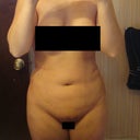 After (7 Days) - Front (not that's not a shadow around my pubic area...that's a bruise