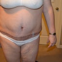 My seroma underneath my bb all the way across