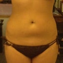 Front - 6 weeks post-procedure