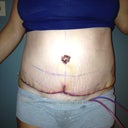 2 Days PO SWOLLEN!