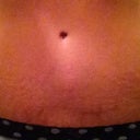 Scar after 1 and a half year mark