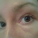 Puffy, swollen, botox eyes
