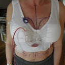 Day After Surgery