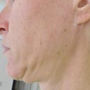 After 1 year