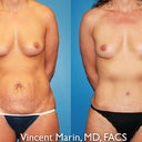 6 months post surgery