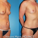 6 months post surgery