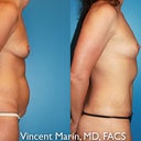 6 months post surgery