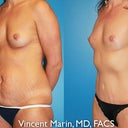 6 months post surgery