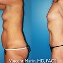 6 months post surgery