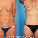 6 months post surgery