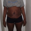 Preop front view