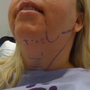 These are the marks Dr. Leedy made just prior to surgery.