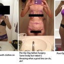pre-op to post-op