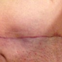 Scar at 6 weeks