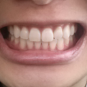 Braces are off. My left upper looks shorter than my right. If my right was taken inwards a bit more maybe I'd be happier.