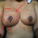 day 25 - the right breast is still swollen  :((