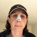 Day 2.  SO swollen.  I look like a Dr Seuss character with my chubby cheeks immobile upper lip.